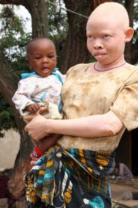 Albino Women Bare Pussy Pics In Africa 3
